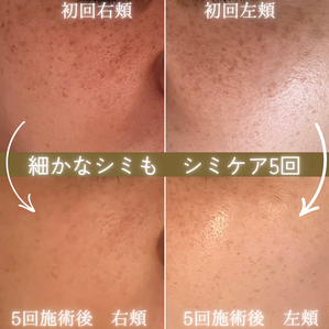 シミケア　ビフォーアフター