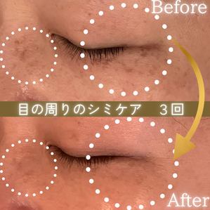 シミケア　ビフォーアフター