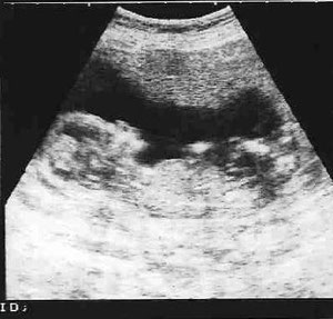 échographie à la 10ème semaine de grossesse
