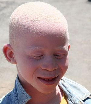 Un enfant albinos (ses parents ont la peau de couleur noire). Sources: wikipédia.