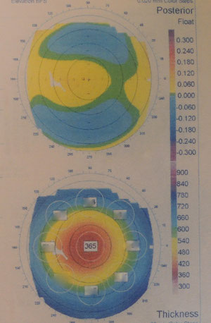 トポグラフィー（実物）。角膜の形状を色で判断する図なのでカラーじゃないと何の役にも立ちません・・・。