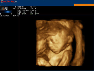 3D / 4D (immagine tridimensionale di un feto) - http://medicalidea.jimdo.com - Vendita Ecografi Usati
