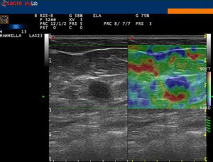 Cisti (tre strati di colori diversi) - http://medicalidea.jimdo.com - Vendita Ecografi Usati