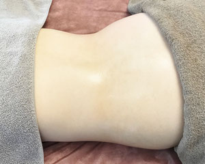 パーフェクトスリムを片側の腰に施術