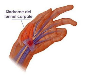 cure per la sindrome del tunnel carpale