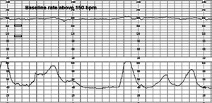 FRECUENCIA CARDIACA BASAL