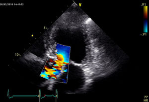 Subaortenstenose im Farbdoppler