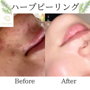 美肌ニキビ　ビフォーアフター