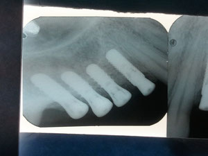 Radiografí post-operatoria de implantes Straumann colocados según diseñoo programado