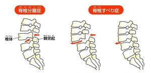 脊椎分離