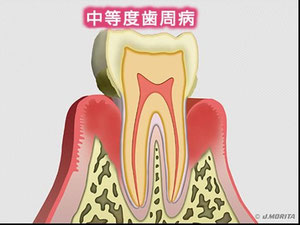 中等度の歯周病の模式図。でもこれだと重度ですね。