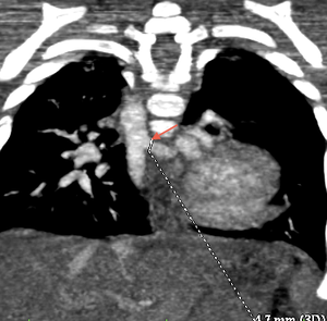 Collatérales aorto-pulmonaires en scanner