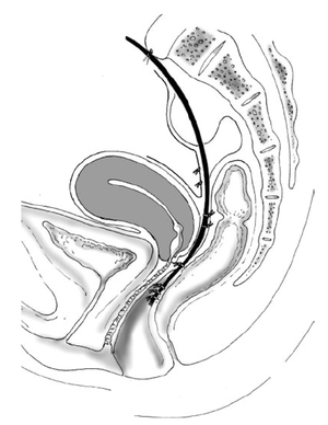 Rectocolpopexia ventral