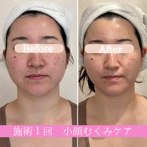 小顔リフト　ビフォーアフター