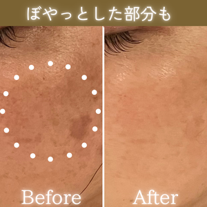 シミケア　ビフォーアフター