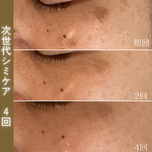 シミケア　ビフォーアフター