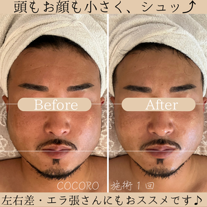 頭蓋骨矯正　ビフォーアフター