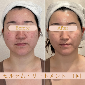 小顔リフト　ビフォーアフター