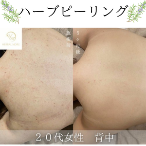 小顔リフト　ビフォーアフター