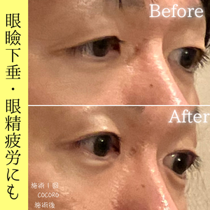 眼瞼下垂　目の開き　ビフォーアフター