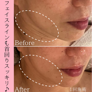 目元のクマ・たるみケア！ビフォーアフター