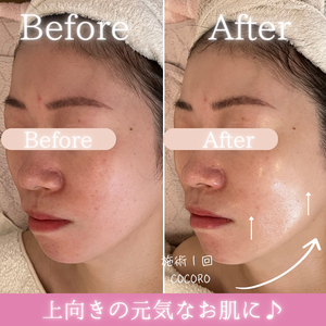 小顔リフト　ビフォーアフター