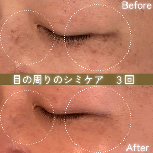 シミケア　ビフォーアフター