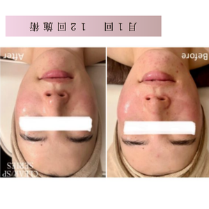 美白　ビフォーアフター