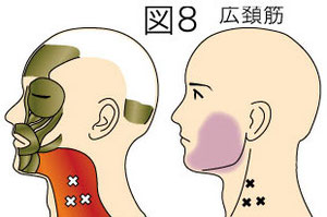広頚筋トリガーポイントによる顔の痛み