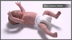 Réflexe de Moro Réflexe archaïque ou réflexe de défense