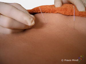 Akupunktur - Physio Mindl