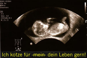 Baby, schwanger, Übelkeit, Erbrechen, Schwangerschaftsübelkeit, HCG, Hormone, Hyperemesis, Gravida, HG, Kinderwunsch, Stillen, Ultraschall, Kaiserschnitt, PDA, Wehen