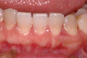 薄い歯茎