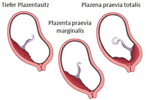 Störungen der Plazenta - schwangerschaftsfahrplan.de