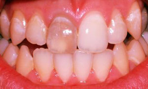 Ein einzelner dunkler Zahn wirkt auffällig störend