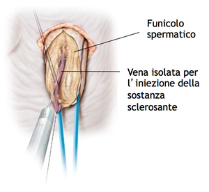 Sclerotizzazione anterograda sec. Tauber