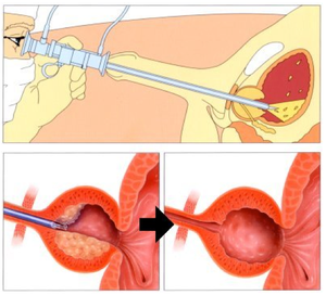 prostata con adenoma bilobato