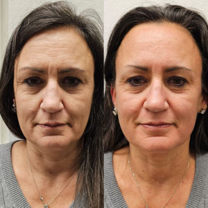 Anti Aging 