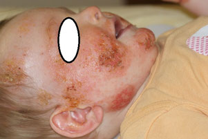 photo d'eczéma infecté des joues d'un bébé