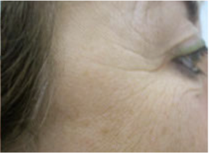 Faltenreduzierung mit OrganicSeries Hyaluronsäure