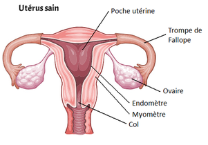 utérus sain, ovaires, absence d'Endométriose