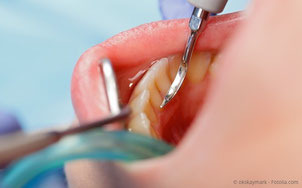 Bei der professionellen Zahnreinigung (PZR) werden Zahnstein, Bakterienbeläge und Verfärbungen entfernt. (© okskaymark - Fotolia.com)