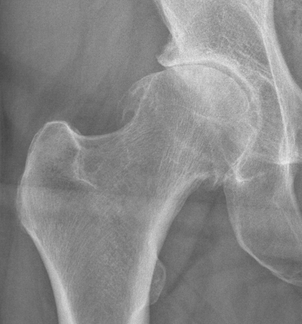 Coxarthrose, Koxarthrose, Arthrose Hüfte