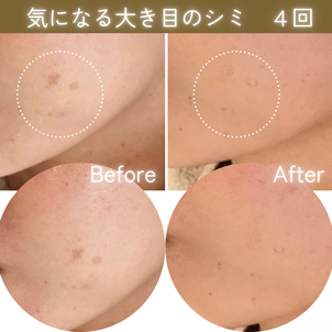 シミケア　ビフォーアフター
