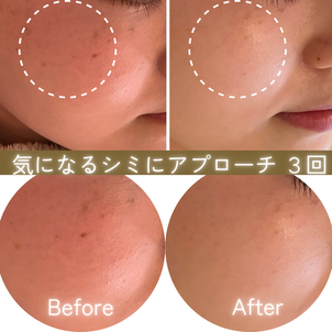 シミケアの効果　ビフォーアフター