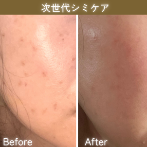 シミケア　ビフォーアフター