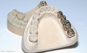 Bei Zahnersatz sollte die PZR in kürzeren Abständen erfolgen. (© O.K. - Fotolia.com)