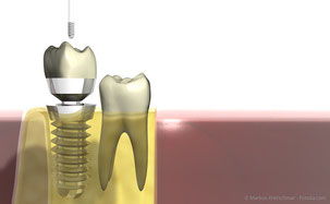 Für Implantate müssen bei der PZR spezielle Instrumente verwendet werden. (© Markus Kretschmar - Fotolia.com)
