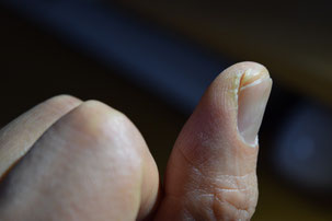 左親指。10年以上使い続けている爪切りで、誤って肉を切り込んでしまった、とまず思った傷口。この写真では血の気はないけれど、つつけば血が出てきそうな気配だった。しかーし、どう考えても爪切りがあたったのではないことに妻の一声で気づいた。そう、これは寒さでやられた、酷いあかぎれ（ひび割れ）だった。踵だけでなく、指もひび割れするとは思いもよらなかった。零下５℃くらいを越えるとどうも敏感に反応する模様。