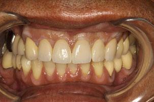 歯茎の再生と審美歯科
